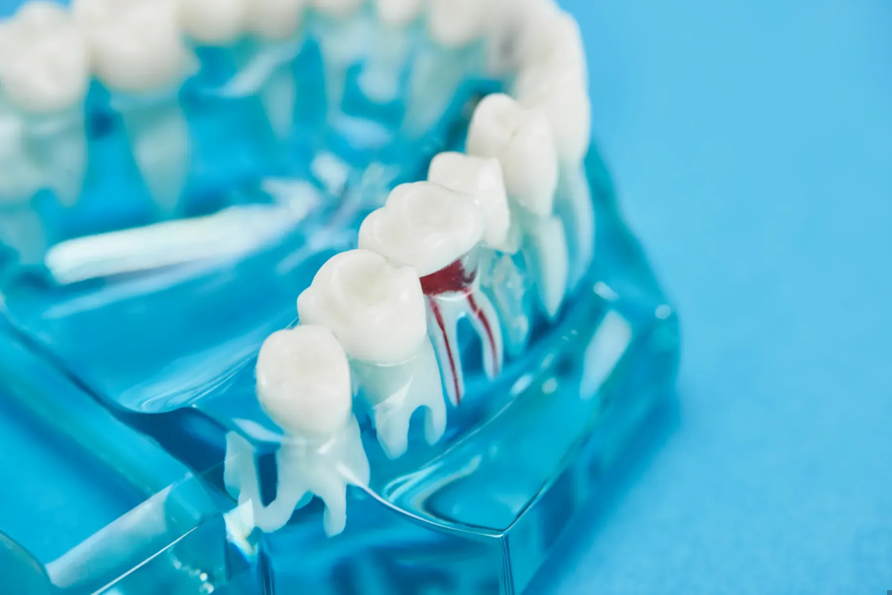 What happens if you don't get a root canal?