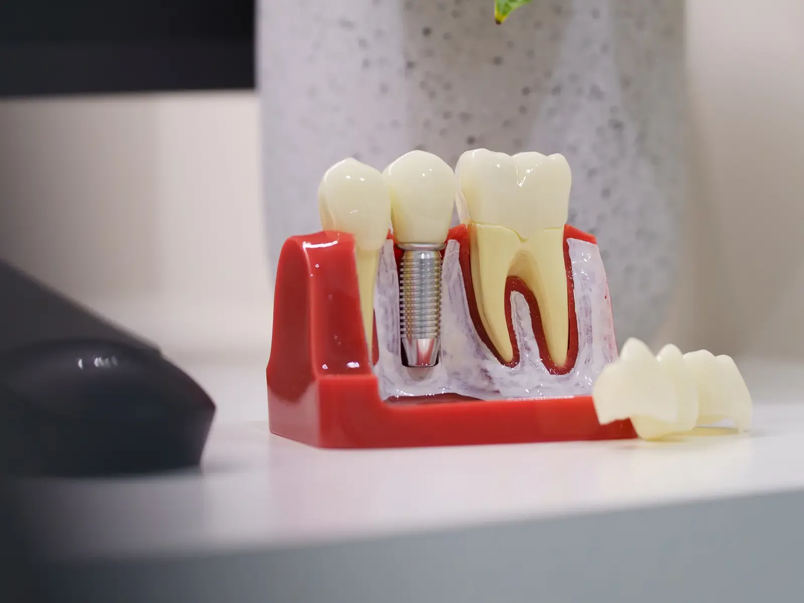 A dental implant teaching model at Creekside Dental Langley