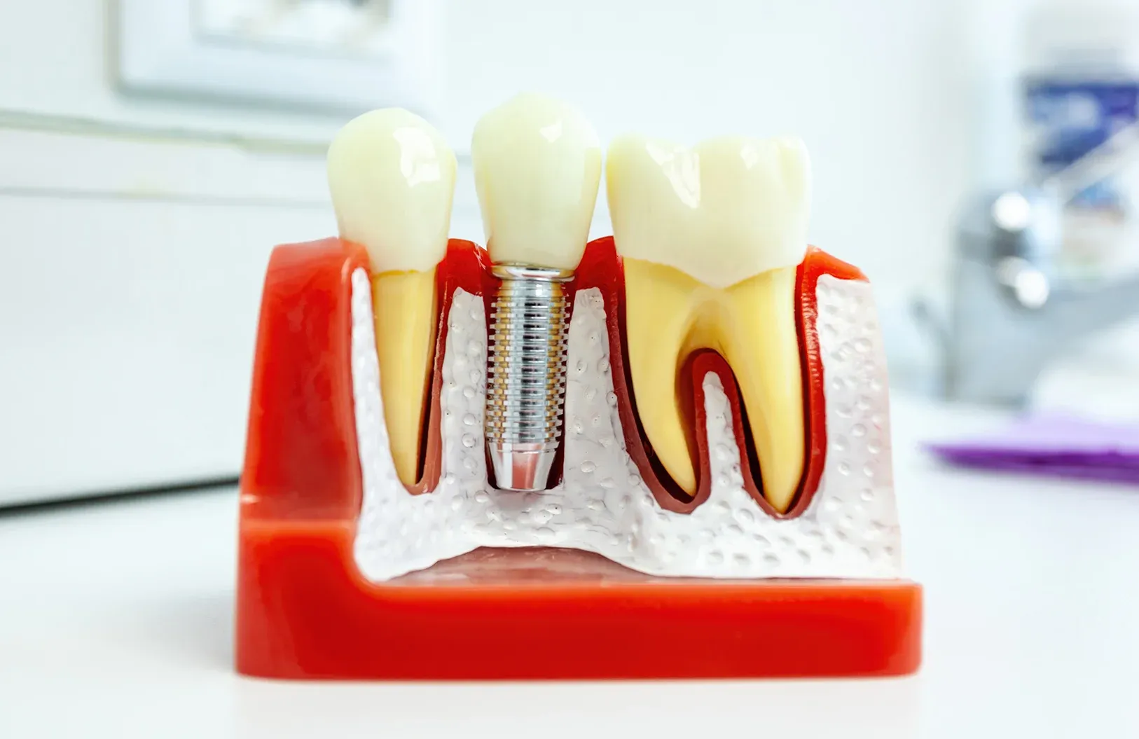 The complete guide to dental implants