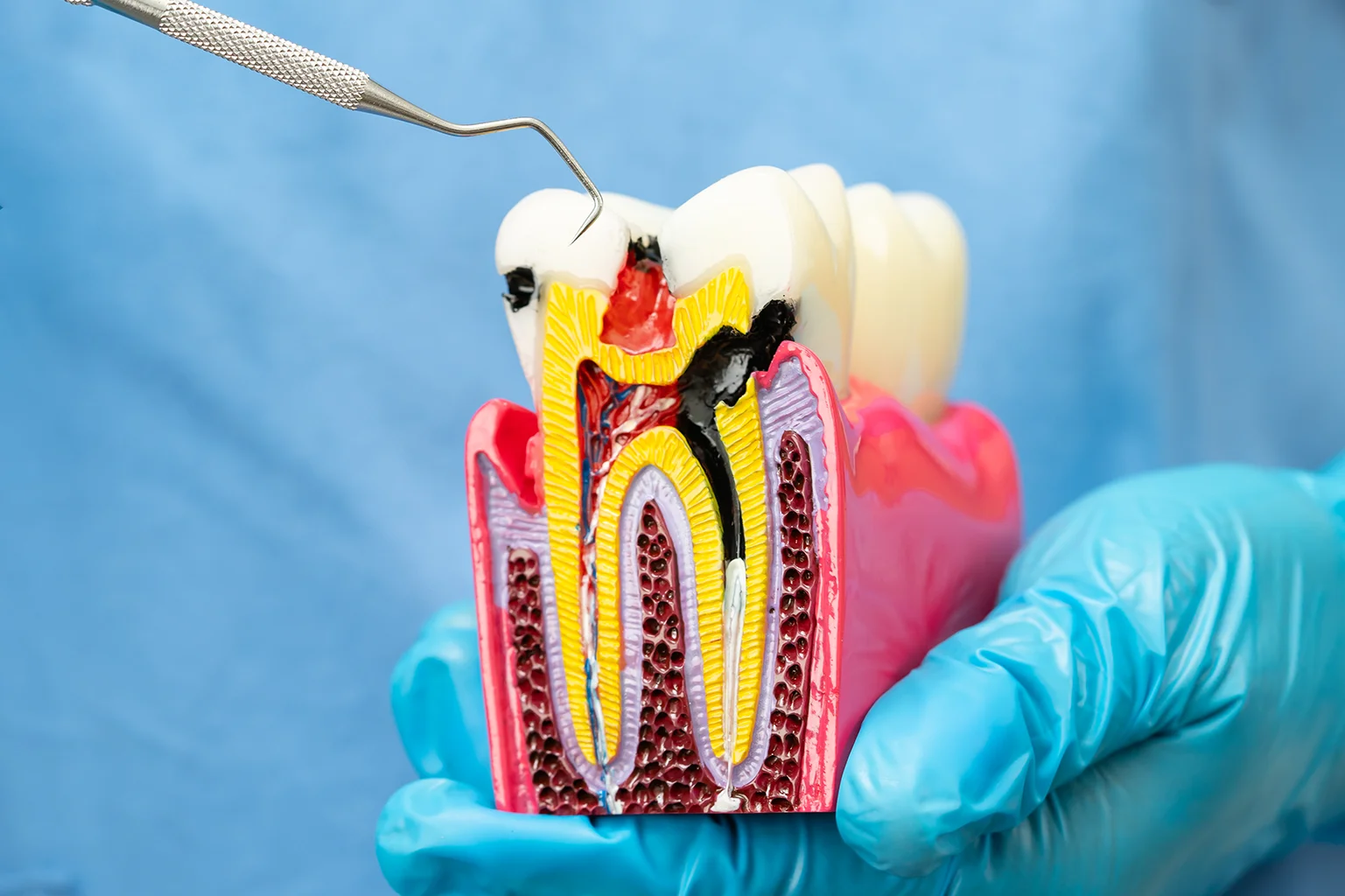 root canal in langley
