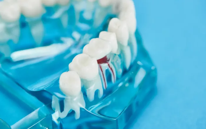 Illustration showing the consequences of delaying root canal treatment